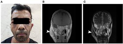 Case report: Bilateral spinal neurofibromatosis